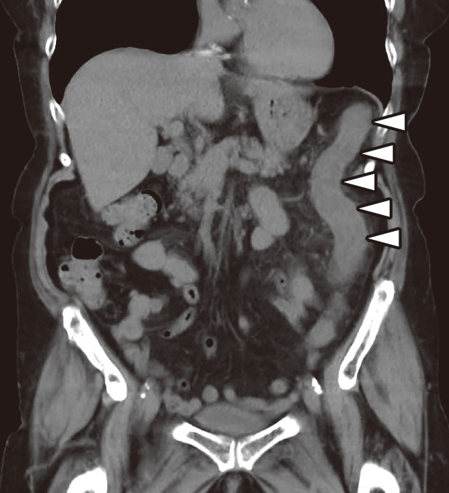 ⓔ図11-5-3　腹部CT画像 下行結腸に広範に著明な壁肥厚を認め，内腔は狭細化している．