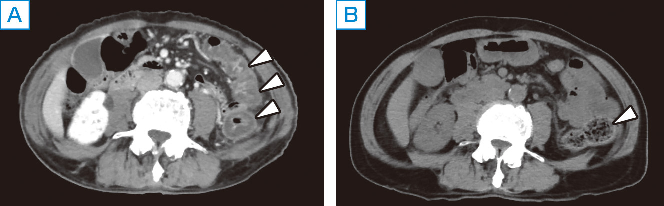 ⓔ図11-5-4　腹部CT画像 左：下行結腸，横行結腸に三層構造を伴う著明な壁肥厚を認め，内腔は狭細化している． 右：1カ月後CT所見では，下行結腸の壁肥厚は改善し，内腔に便の貯留を認める．
