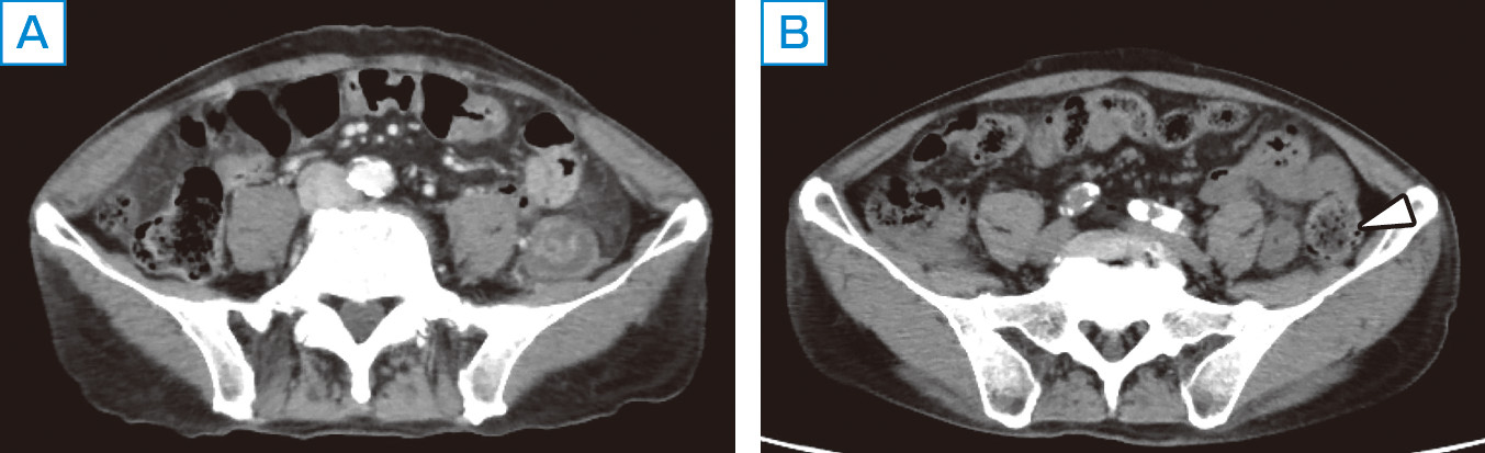 ⓔ図11-5-5　腹部CT画像 左：下行結腸に三層構造を伴う著明な壁肥厚を認める．内側から，粘膜，粘膜下層，筋層＋漿膜下層の一部．粘膜下層の著しい肥厚を認める． 右：1カ月後CT所見では，下行結腸の壁肥厚は改善し，内腔に便の貯留を認める．