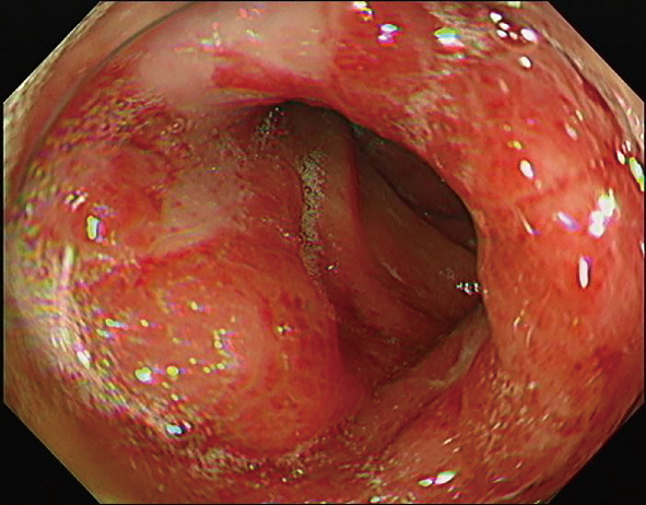 ⓔ図11-5-7　下行消化管内視鏡像 (2) 全周性の粘膜の発赤ときわめて高度の粘膜浮腫を認め，送気しても内腔の拡張が不十分である．