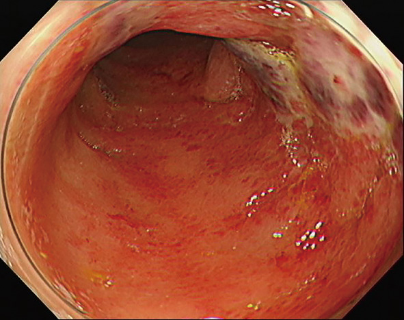 ⓔ図11-5-8　下行結腸内視鏡像 (1) 3/4周程度の発赤粘膜を認め，中央の縦走する潰瘍は白苔で覆われている．