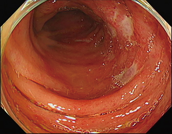 ⓔ図11-5-9　下行結腸内視鏡像 (2) 片側性の発赤粘膜を認め，浅い潰瘍が帯状に分布している．