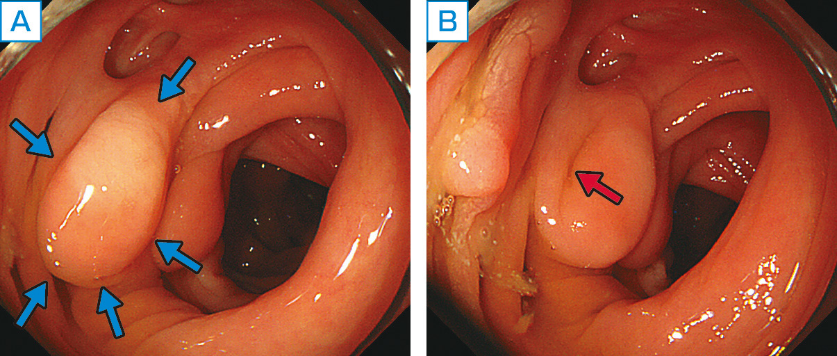 ⓔ図11-8-1　S状結腸の反転憩室 A：表面平滑な大腸ポリープのごとくに観察される (青矢印)． B：内視鏡で送気し，結腸内を加圧すると隆起部分が憩室内に格納され，憩室口が明瞭になる (赤矢印)．反転憩室をポリープと見誤ってポリペクトミーを施行すると大腸穿孔をきたすので注意が必要である．