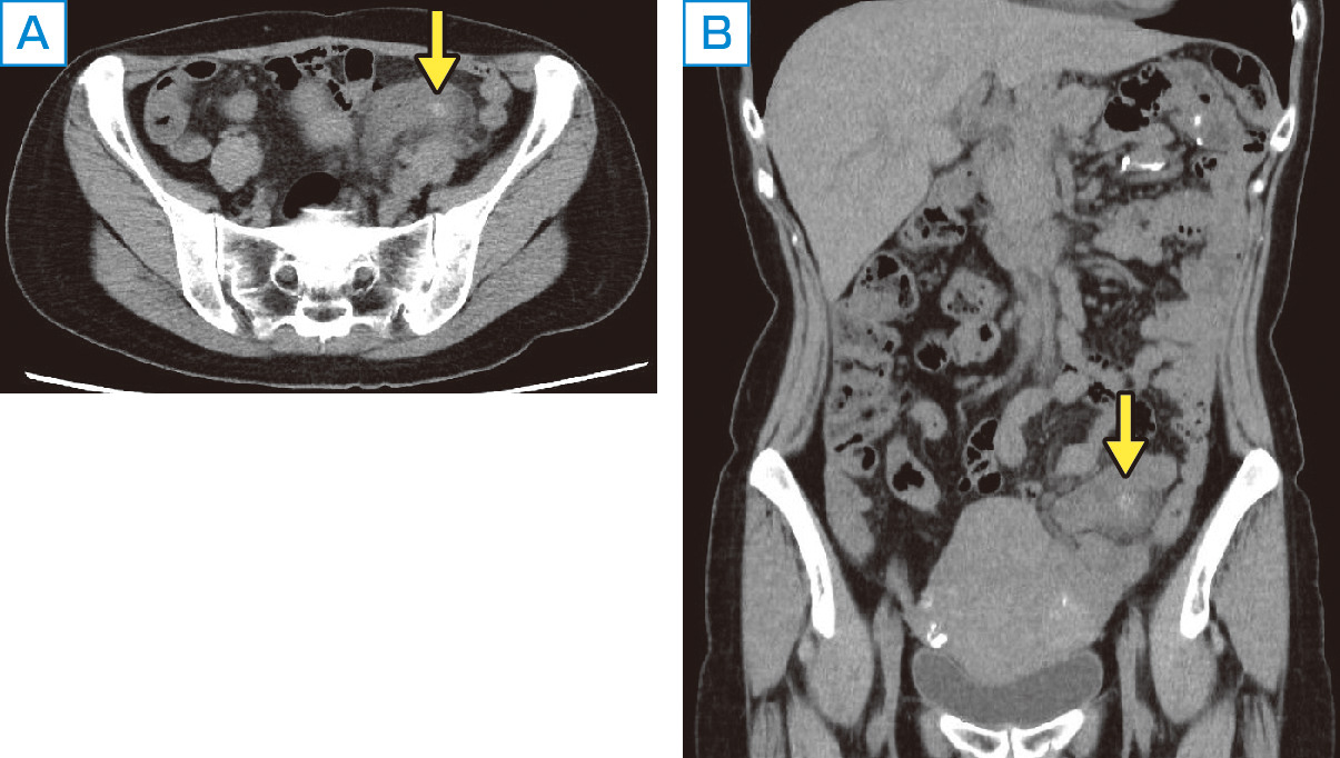 ⓔ図11-8-5　S状結腸憩室炎のCT画像 A：腹部CT検査でS状結腸壁の肥厚，周囲脂肪織濃度の上昇を認める (黄色矢印)． B：CT画像 (前額断像)．