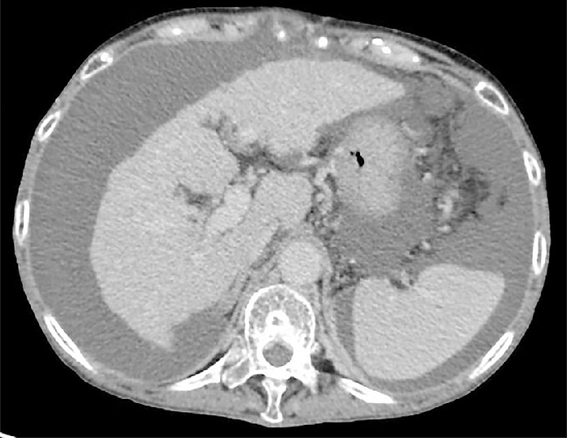 肝硬変患者における腹水の潜在的な合併症にはどのようなものがありますか?