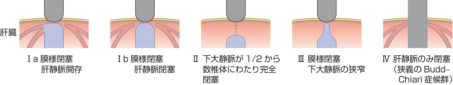 ⓔ図12-17-1　杉浦分類 ①下大静脈，②肝静脈．