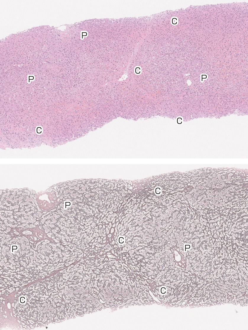 ⓔ図12-17-2　Budd–Chiari症候群の肝組織像 上段：Hematoxylin–Eosin (HE) 染色，下段：鍍銀染色，P：門脈域，C：中心静脈域．肝小葉の逆転像 (門脈域が小葉中央に位置した像)，中心静脈域の線維化および線維性隔壁の形成がみられる．