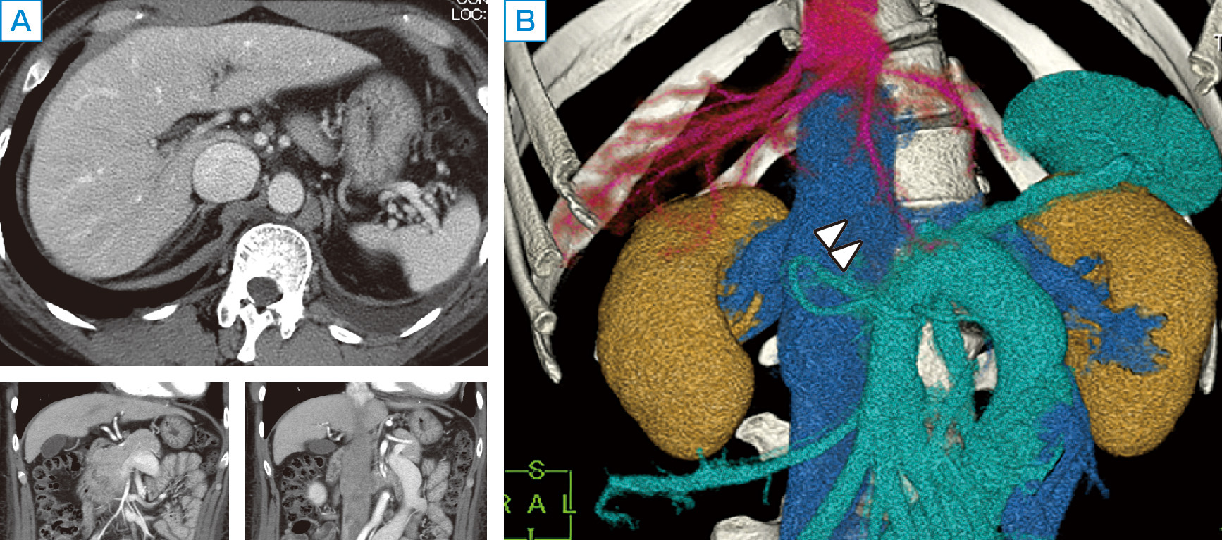 ⓔ図12-17-3　先天性門脈欠損症の腹部画像所見 A：腹部造影ダイナミックCTの横断面 (上段)，矢状面 (下段) では肝門部の門脈が描出されていないように見えるが，血管像はイメージしにくい． B：3D–CTとして画像を再構築することで門脈本幹が欠損し (白矢頭)，拡張した下腸間膜静脈が左腎静脈と連続してP–Vシャントを形成しているのが明瞭に認識できる．