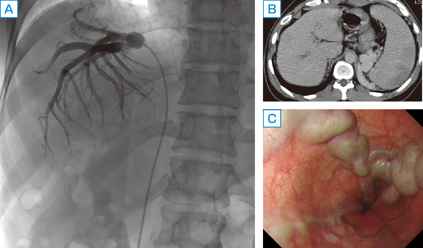 ⓔ図12-17-5　特発性門脈圧亢進症の画像所見 A：肝静脈造影におけるしだれ柳様変化，B：腹部CTにおける巨脾と側副血行路，C：上部消化管内視鏡検査における食道静脈瘤．