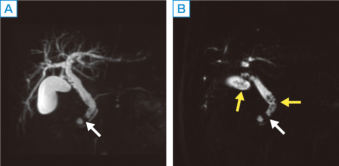 ⓔ図12-23-2　胆嚢結石，総胆管結石症例の3D–MRCP画像 A：3D–MRCP，MIP像，B：3D–MRCP元画像． 下部総胆管と胆嚢頸部に複数の総胆管結石と，胆嚢結石が陰影欠損として認められ，上流の胆道拡張を認める．大きな結石はMIP像でも指摘が容易 (白矢印) であるが，微小な結石は元画像 (B) を用いると詳細に評価できる (黄色矢印)．