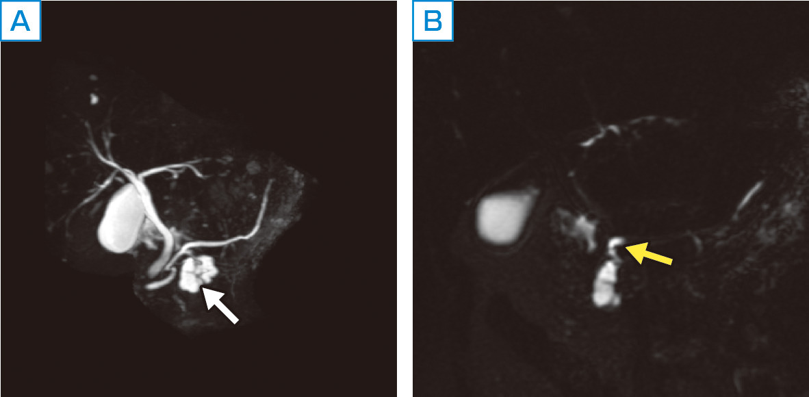 ⓔ図12-23-3　膵囊胞性病変 (分枝型IPMN) の3D–MRCP画像 A：3D–MRCP，MIP像，B：3D–MRCP元画像． 膵頭部に27 mm大の多房性囊胞性腫瘤を認める (白矢印)．主膵管の拡張は目立たない．3D–MRCP元画像 (B) では主膵管と囊胞性病変の連続を認め (黄色矢印)，分枝型IPMNの診断に有用である．