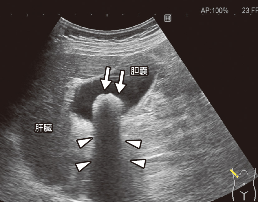 ⓔ図12-23-4　胆嚢結石の超音波像 右季肋部縦走査で肝臓の下方に胆嚢を認める．壁は平滑で内腔な無エコーである．胆嚢内に音響陰影 (矢頭) を伴う結石 (矢印) が認められる．