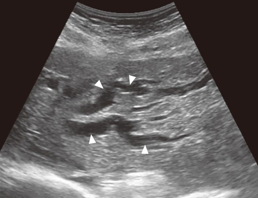 ⓔ図12-23-5　閉塞性黄疸の肝内胆管超音波像 肝左葉内に拡張した肝内胆管像 (矢頭) を認める．