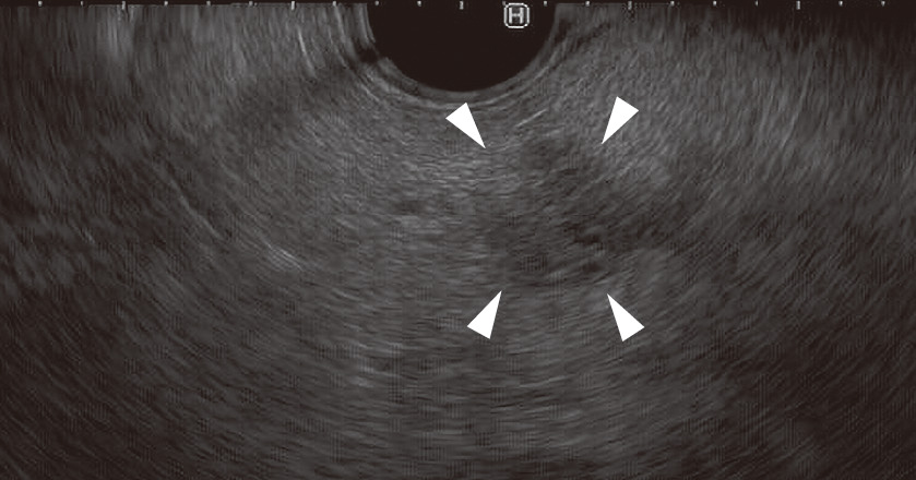 ⓔ図12-23-6　膵体部癌の超音波内視鏡像 胃から膵体部を観察している．膵体部に約1 cmの辺縁不整の低エコー腫瘤 (矢頭) を認める．