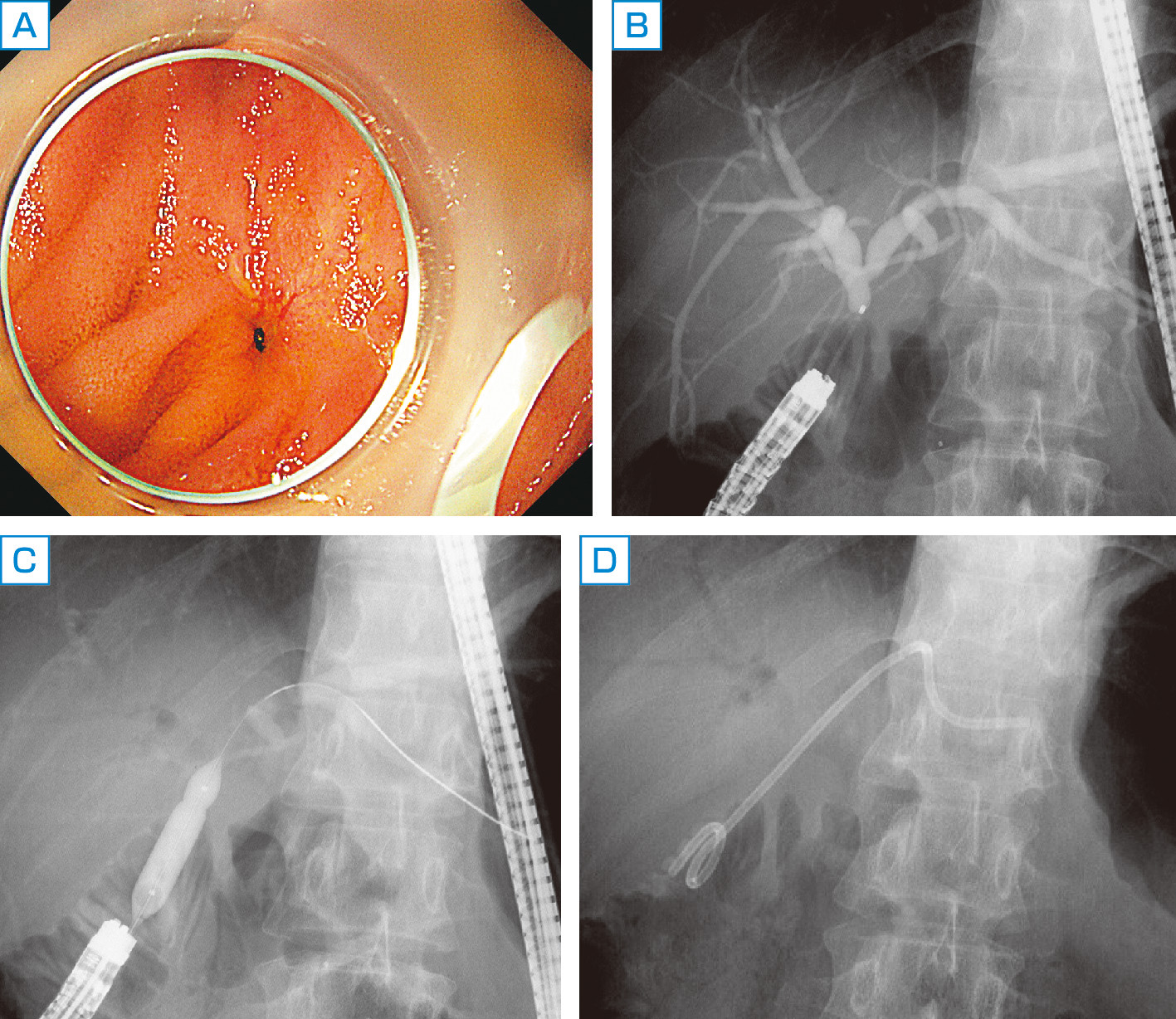 ⓔ図12-23-9　膵頭部癌術後の胆管空腸吻合部狭窄 A：吻合部に狭窄がある． B：バルーン内視鏡下ERCPで肝内胆管は拡張している． C：狭窄部をバルーンで拡張している． D：狭窄部に胆管ステントが留置されている．