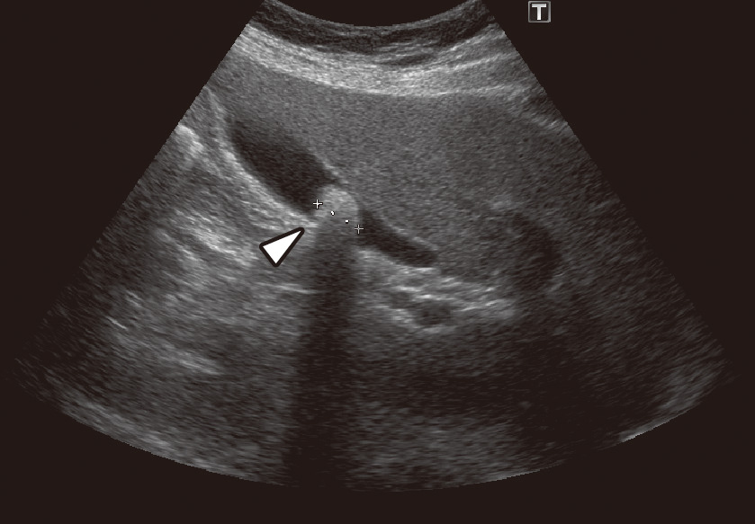 ⓔ図12-24-2　腹部超音波検査 胆嚢結石 (白矢頭)．