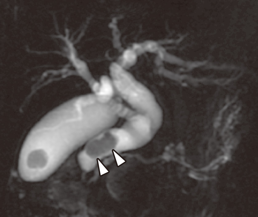 ⓔ図12-24-3　磁気共鳴胆管膵管造影 (MRCP) 総胆管結石 (白矢頭)．