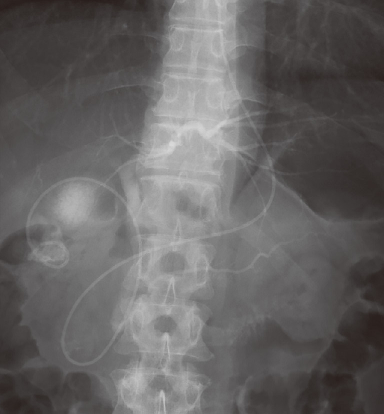 ⓔ図12-24-4　内視鏡的経乳頭的胆嚢ドレナージ術 (ENGBD) 急性胆嚢炎に対して，内視鏡的に経鼻胆嚢ドレナージチューブを留置している．
