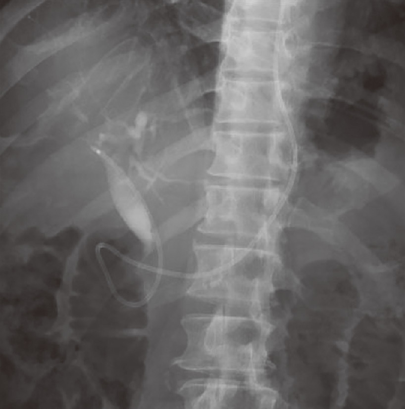 ⓔ図12-24-5　内視鏡的経鼻胆管ドレナージ術 (ENBD) 急性胆管炎に対して，内視鏡的に経鼻胆管ドレナージチューブを留置している．
