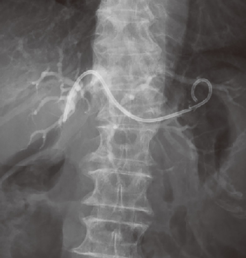 ⓔ図12-24-6　超音波内視鏡下胆管ドレナージ術 (EUS–BD) 急性胆管炎に対して，超音波内視鏡下に胃から胆管を穿刺し，チューブステントを留置している．
