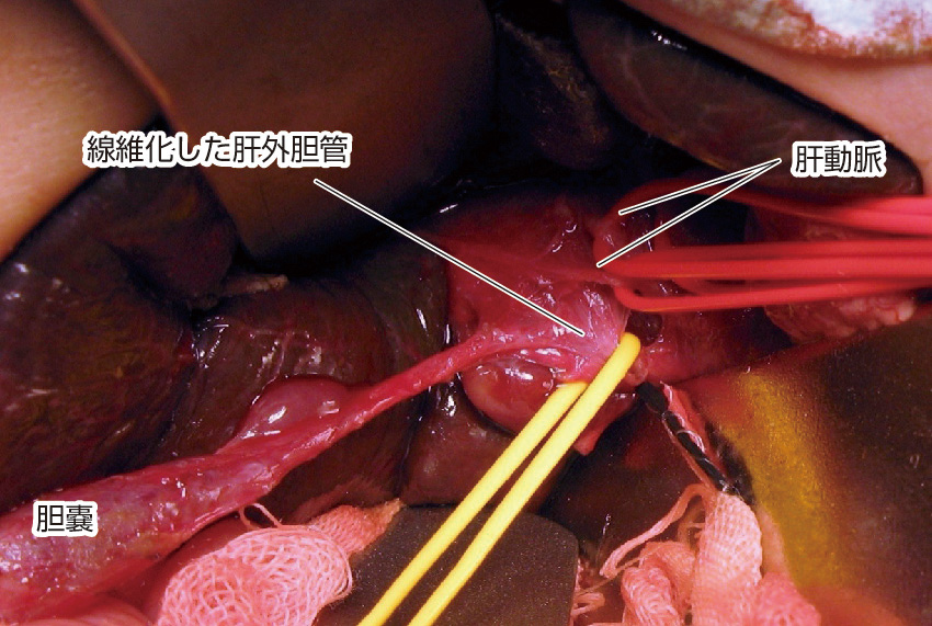 ⓔ図12-25-1　胆道閉鎖症外観 