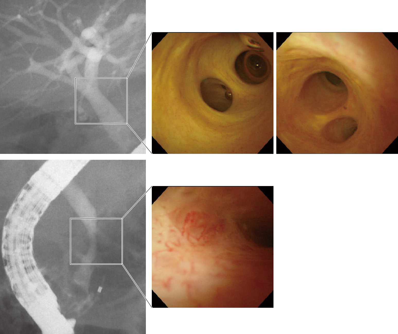 ⓔ図12-25-10　IgG4関連硬化性胆管炎 (ステロイド加療後) 肝門部狭窄は改善．経口胆道鏡で狭窄部の浮腫，血管増生は消失した．胆管癌が鑑別に挙がる，顆粒状粘膜の出現を認めた．