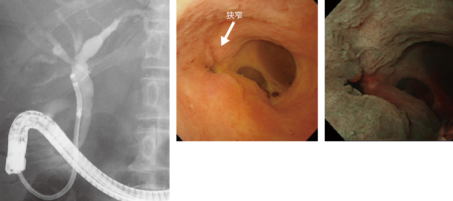 ⓔ図12-25-11　胆嚢摘出後胆管狭窄 8カ月後のフォローでは，狭窄の著明な改善は認められなかった．また．POCS (peroral cholangioscopy) では，血管の増生を認めず，生検結果でも悪性所見はなかった．