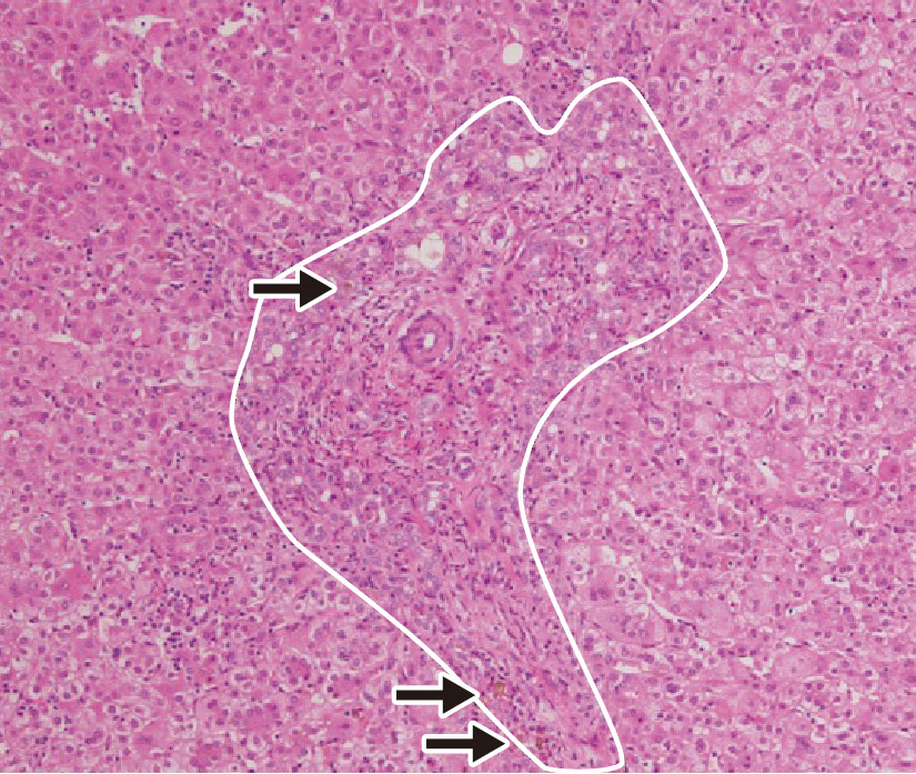 ⓔ図12-25-2　胆道閉鎖症の肝生検所見 →：胆汁うっ滞に伴う胆汁栓 –：拡大した門脈域と炎症細胞浸潤，および周囲の増生胆管