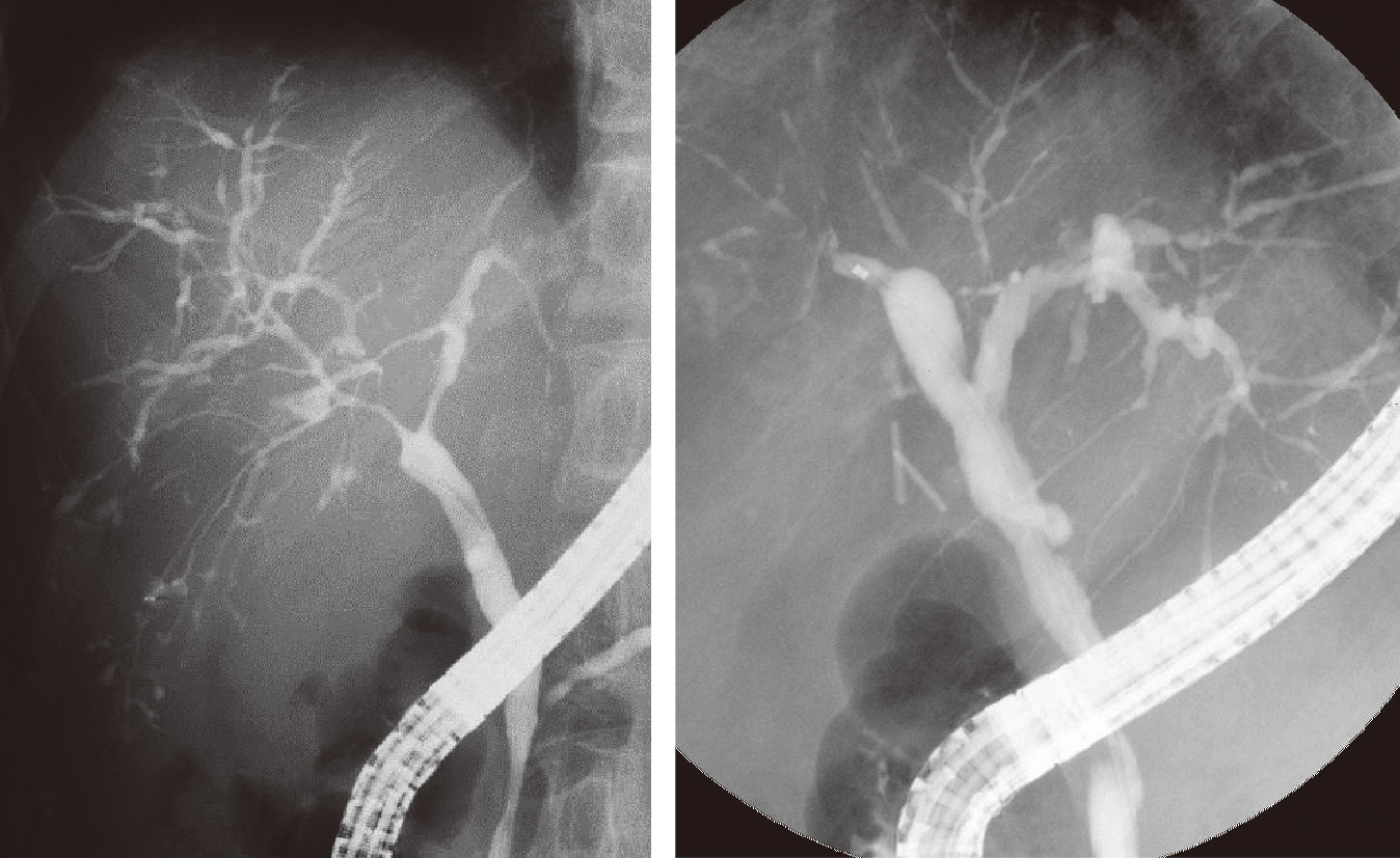 ⓔ図12-25-4　原発性硬化性胆管炎 肝内胆管にびまん性に帯状狭窄や数珠状変化を認める．