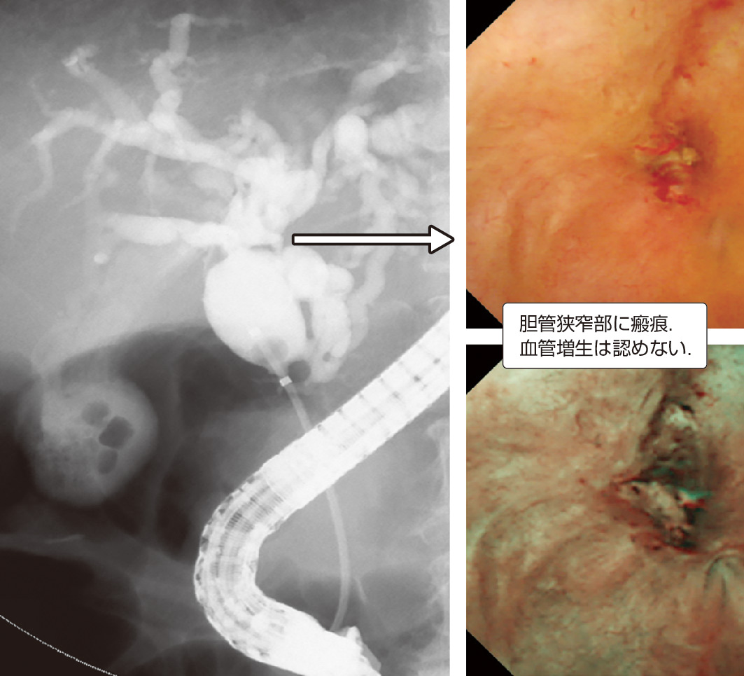 ⓔ図12-25-5　PSC経口胆道鏡の内視鏡像 胆管狭窄部に瘢痕，血管増生は認めない．