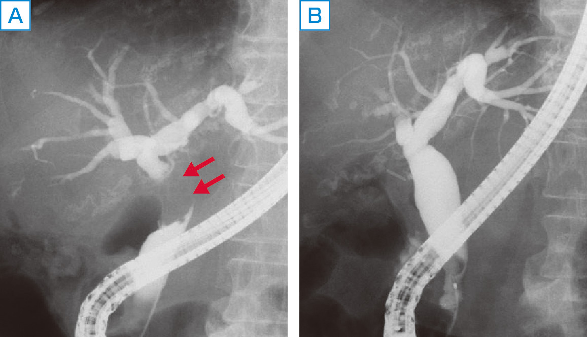 ⓔ図12-25-6　Mirizzi症候群 A：胆嚢頸部の陥頓結石により総胆管圧排． B：胆嚢摘出後，総胆管狭窄は改善．