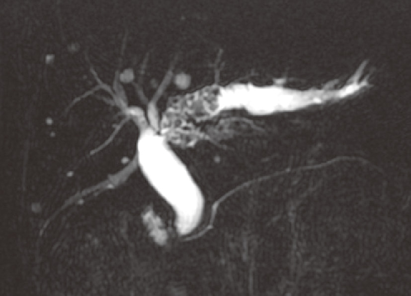 ⓔ図12-25-7　肝内胆管結石症のMRCP像 左肝管に多発結石を認め，その肝門合流部に狭窄を伴う．