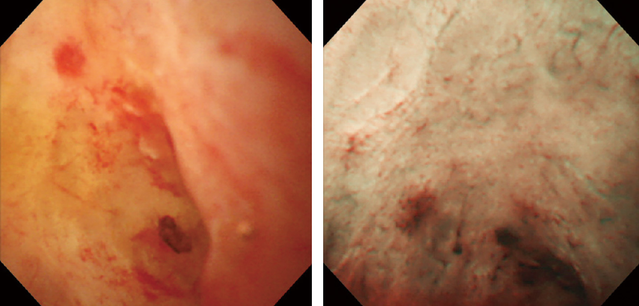 ⓔ図12-25-8　肝門部良性狭窄 (経口胆道鏡の内視鏡像) 狭窄部に炎症性変化を認める．