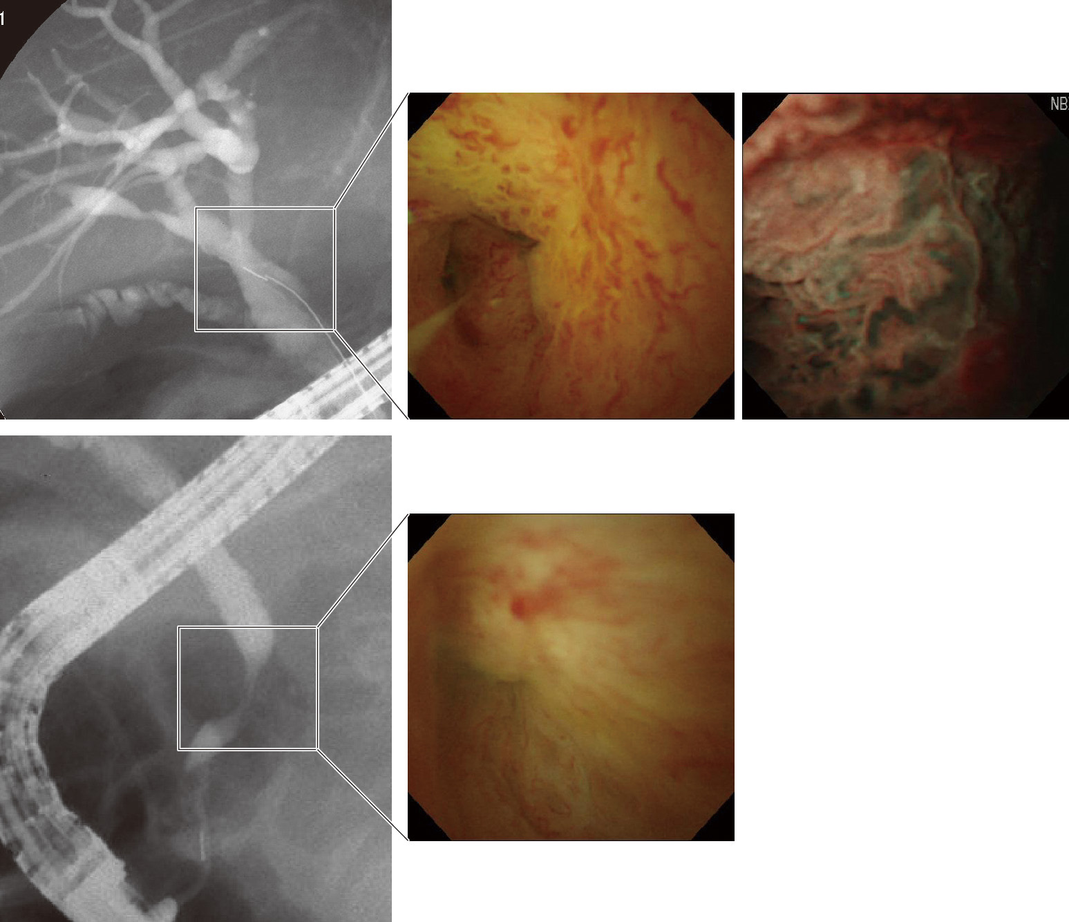 ⓔ図12-25-9　IgG4関連硬化性胆管炎 (治療前) 胆道鏡で血管の増生，蛇行を認める．