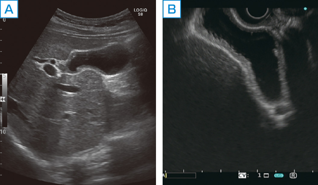 ⓔ図12-26-2　体外式超音波検査 (A) と同じ症例のEUS像 (B) A：胆嚢壁の肥厚を指摘された． B：胆嚢粘膜は肥厚し表面が顆粒状を呈している．