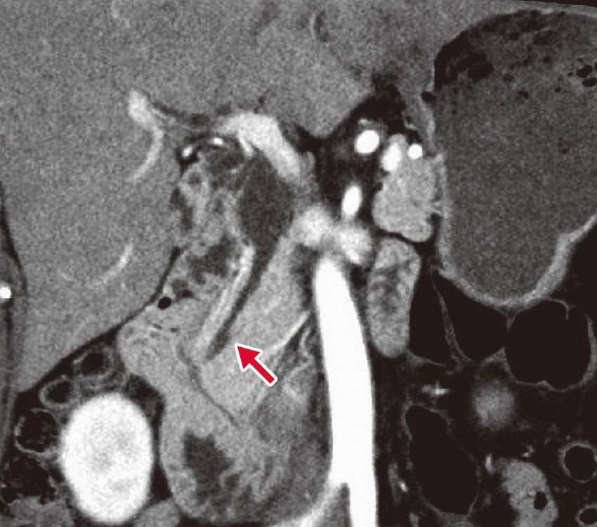 ⓔ図12-27-1　戸谷Ⅳ–A型先天性胆道拡張症のMDCT像 本スライスでは膵管がわずかに指摘できるのみであるが，明らかに十二指腸壁外の膵内で胆管に合流している (矢印)．