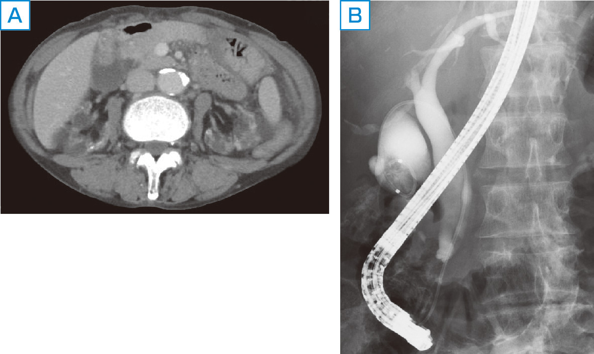 ⓔ図12-28-1　胆嚢癌に対する胆汁細胞診 A：胆嚢底部に軽度造影効果のある隆起性病変を認める． B：ERCPでは胆嚢底部に陰影欠損を認める．内視鏡的経鼻ドレナージチューブを留置し，胆嚢内から胆汁を採取し細胞診を施行した．