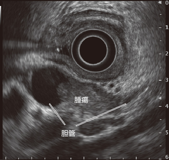 ⓔ図12-28-2　胆管癌のEUS像 