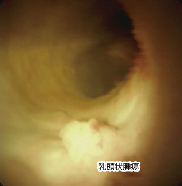 ⓔ図12-28-3　経口胆道鏡による胆管内乳頭状腫瘍の観察 