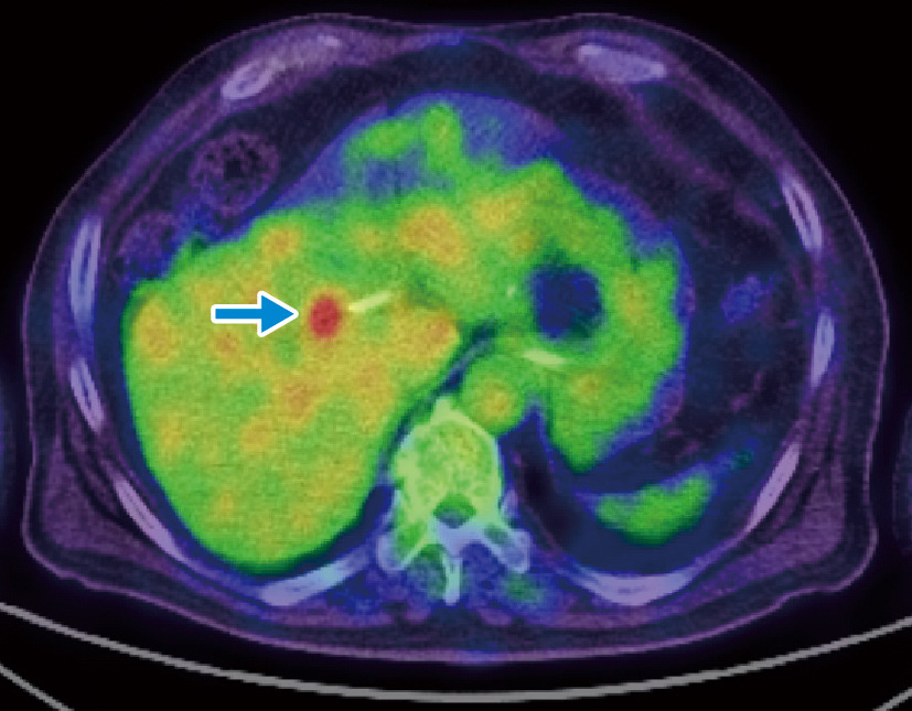 ⓔ図12-28-4　肝門部胆管癌のFDG–PET像 