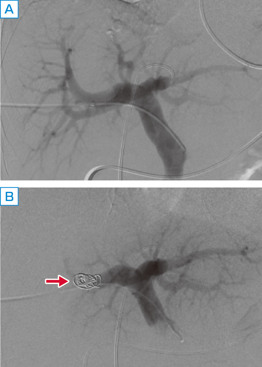 ⓔ図12-28-5　経皮経肝門脈塞栓術 (PTPE) 門脈右枝にコイル (矢印) を留置し，門脈塞栓術を行った．