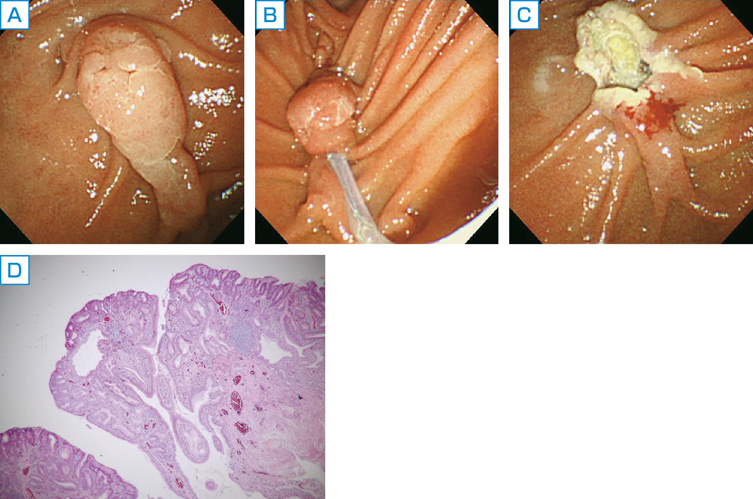 ⓔ図12-28-6　十二指腸乳頭部腺腫 A：十二指腸乳頭部の内視鏡像．家族性大腸腺腫症の患者．上部消化管内視鏡を施行したところ，十二指腸乳頭部に褪色調の腫瘤を認めた． B～D：内視鏡的乳頭切除術．生検の結果は腺腫であったため内視鏡的乳頭切除術を施行した．B：snaring中，C：切除後，D：切除標本の病理で腫瘍は癌の成分を伴わない腺腫と診断され，切除断端も陰性であった．