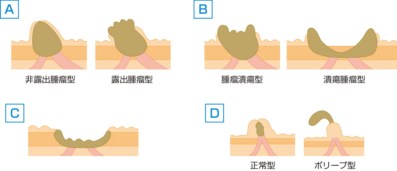 ⓔ図12-28-7　十二指腸乳頭部癌の肉眼的分類 (日本肝胆膵外科学会編：胆道癌取扱い規約 第6版，金原出版，2013) A：腫瘤型，B：混在型，C：潰瘍型，D：その他の型．