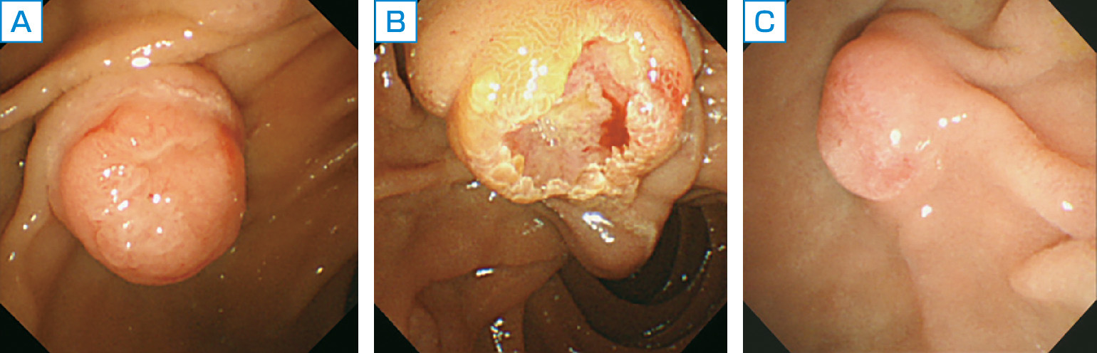 ⓔ図12-28-8　十二指腸乳頭部癌の内視鏡像 A：露出腫瘤型十二指腸乳頭部癌の内視鏡画像，B：潰瘍腫瘤型十二指腸乳頭部癌の内視鏡画像，C：正常型十二指腸乳頭部癌の内視鏡画像．