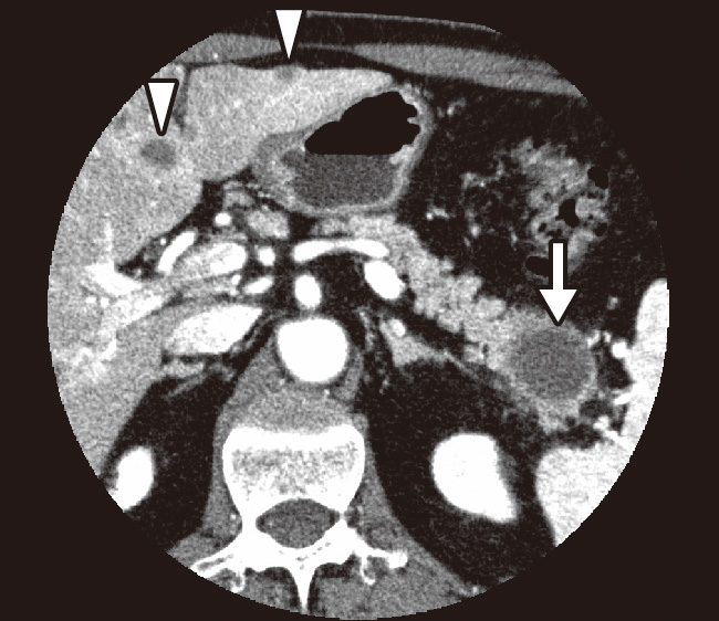 ⓔ図12-29-10　造影CT画像による膵癌 膵臓の尾部に発生した膵癌 (⇩)．肝臓には多発する転移巣が認められる (▽)．