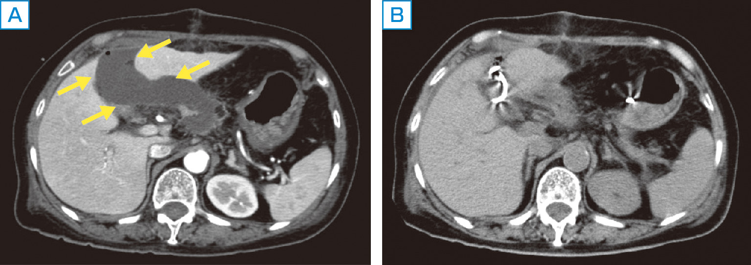 ⓔ図12-29-11　膵液瘻 A：膵頭十二指腸切除後膵液瘻 (70歳代，女性)．術後9日目，CTにて腹腔内膿瘍を認める． B：ドレーン再挿入後，腹腔内膿瘍は消失 (術後12日目)．
