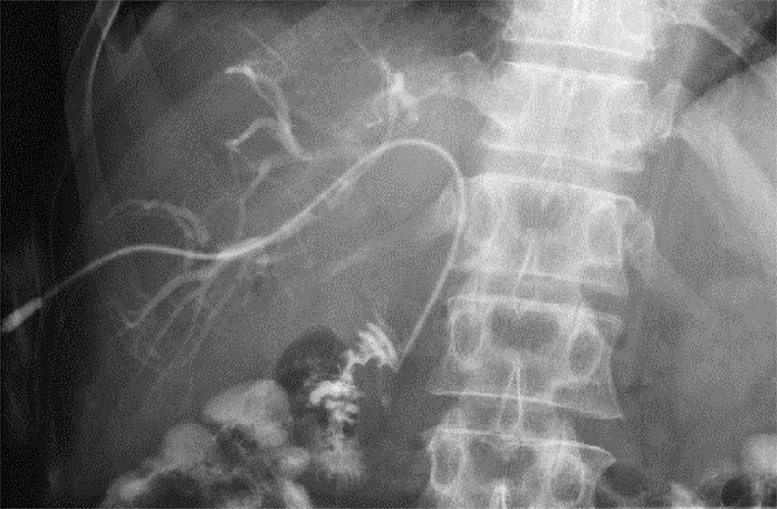 ⓔ図12-29-15　経皮経肝胆道ドレナージ (PTBD) 胆管空腸吻合術が施行されている症例に対して，右肝内胆管より胆管空腸吻合部を通過して空腸へチューブが挿入されている．