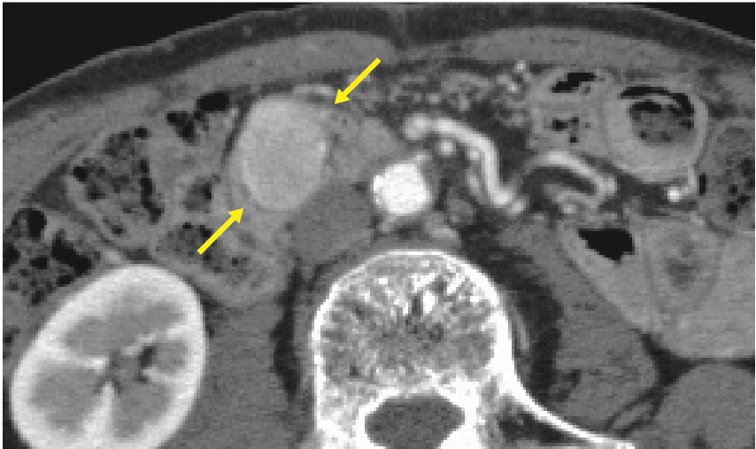 ⓔ図12-29-16　膵NETのCT画像 