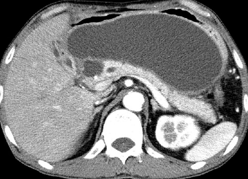 ⓔ図12-29-3　膵仮性嚢胞の造影CT像 
