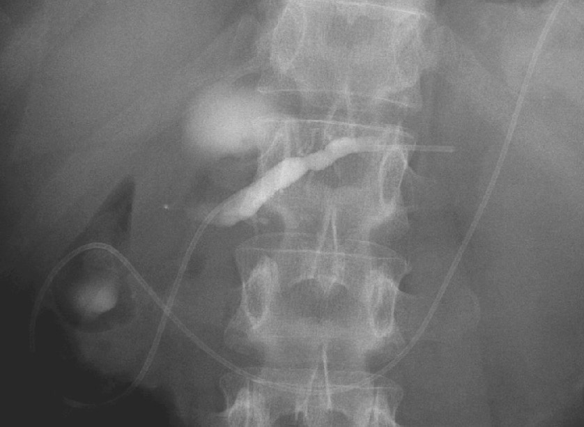 ⓔ図12-29-4　膵仮性嚢胞に対する経乳頭的治療 ENPDを留置した．画面，主膵管上方に嚢胞内への造影剤の貯留を認める．